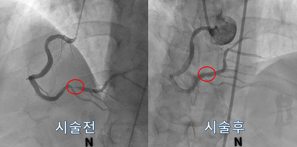 이천병원 스텐스시술 관련 사진(시술 전, 후 비교)